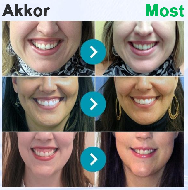 🌟Rolimey® VioCore fogkrém méhméreggel